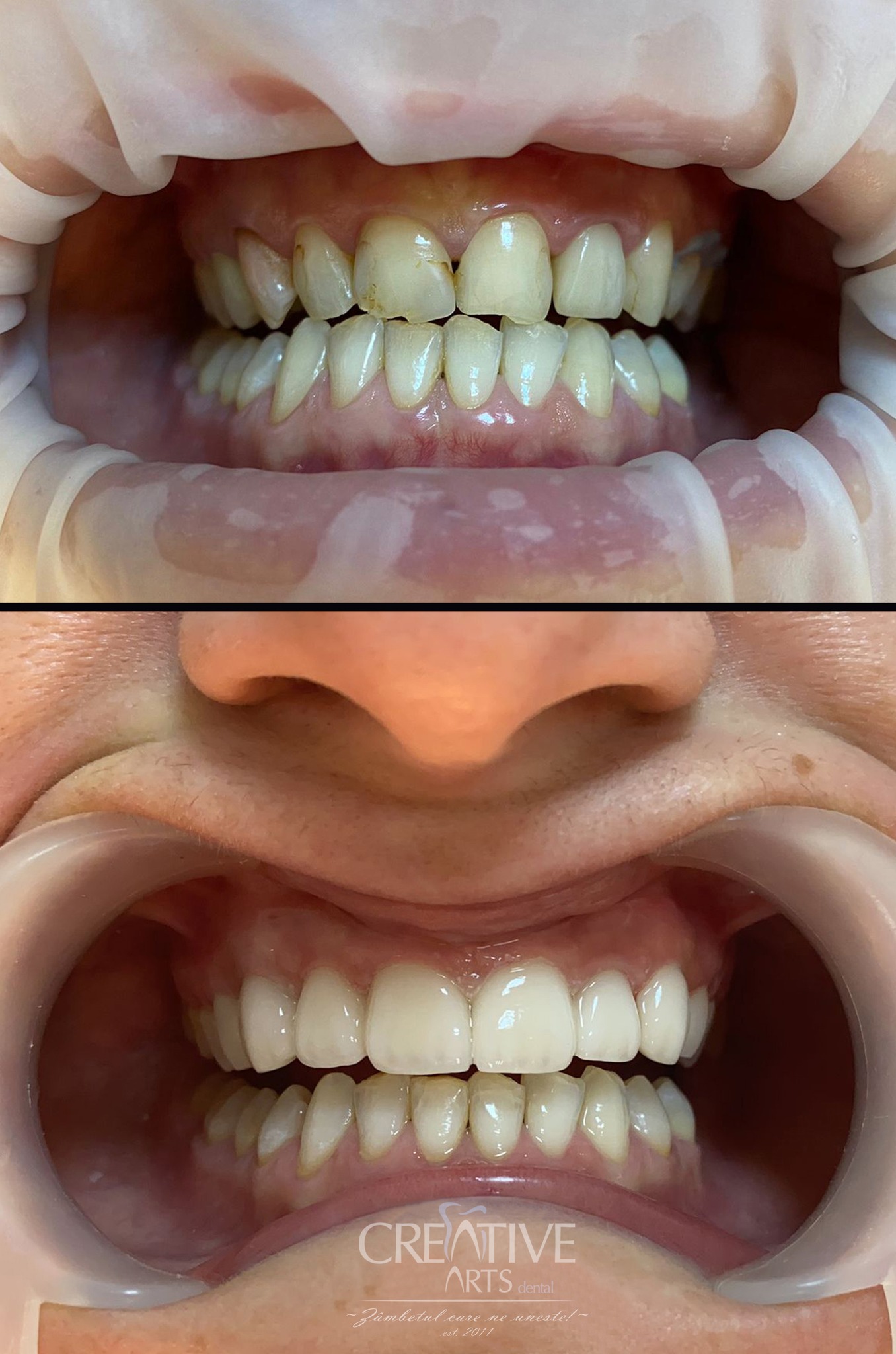 Coroane Zirconiu